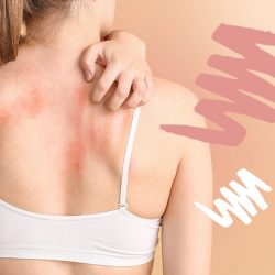 Que faire contre l’eczéma ? Nos solutions au naturel