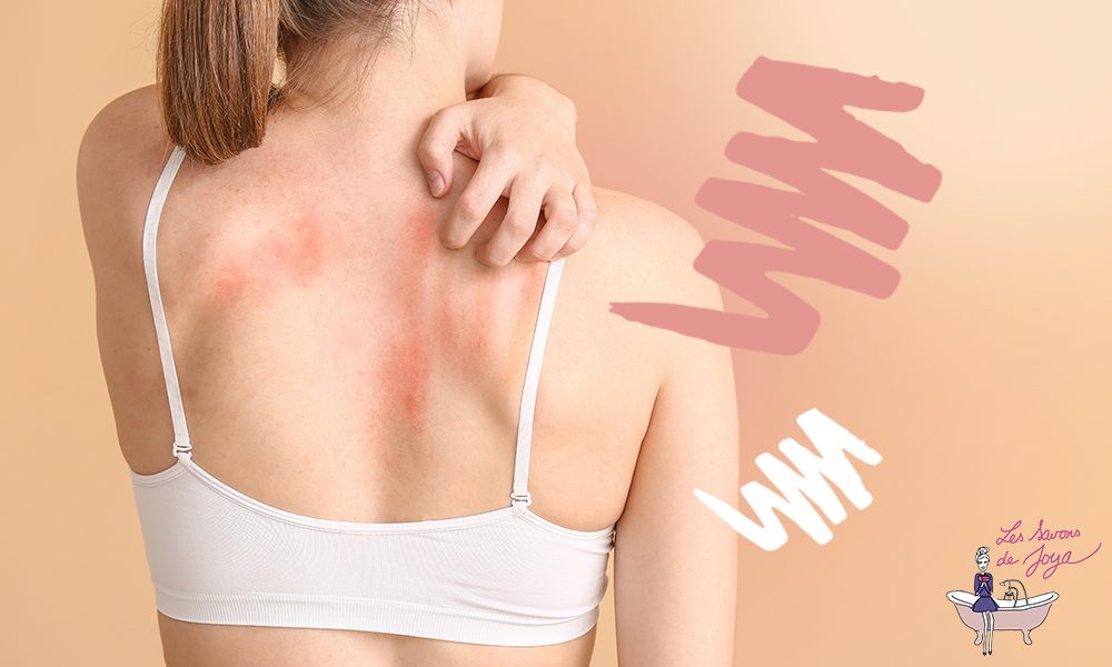 Que faire contre l’eczéma ? Nos solutions au naturel